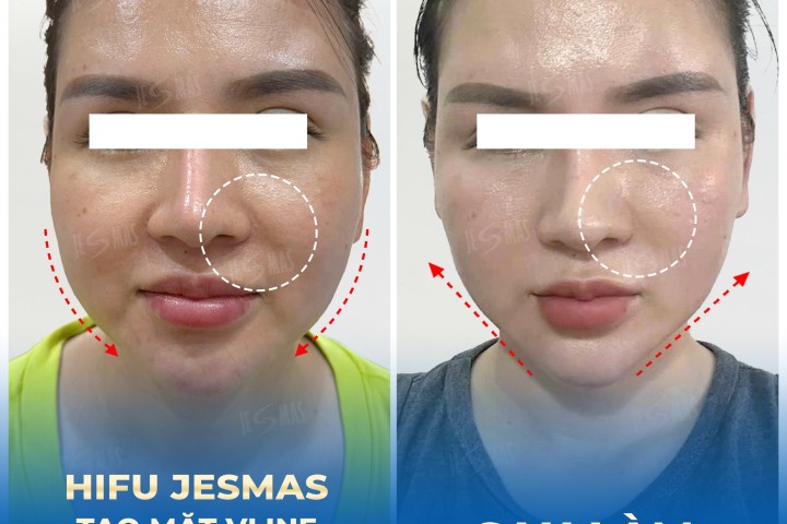 Dịch Vụ Hifu Jesmas Tạo Mặt Vline