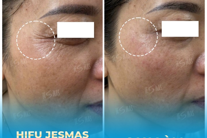 Dịch Vụ Hifu Xóa Nhăn Mắt
