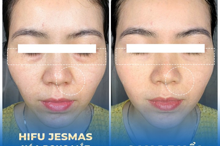 DỊCH VỤ HIFU XÓA NHĂN BỌNG MẮT