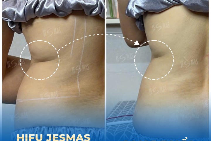 Dịch Vụ Hifu Giảm Mỡ Thăn Xoài