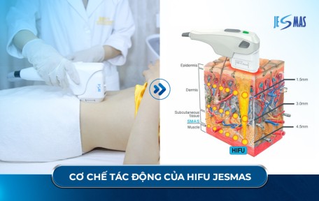 HIFU Giảm Mỡ Có Hiệu Quả Không? Sự Thật Ít Ai Biết Về Công Nghệ HIFU Body