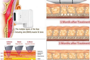 HIFU Hoạt Động Như Thế Nào? Giải Mã Cơ Chế Tác Động Đến Lớp SMAS