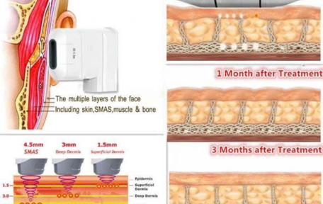HIFU Hoạt Động Như Thế Nào? Giải Mã Cơ Chế Tác Động Đến Lớp SMAS