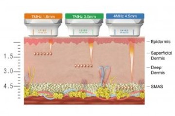 HIFU Có FDA Không? Sự Thật Nhiều Spa Đang Hiểu Sai Về Chứng Nhận FDA