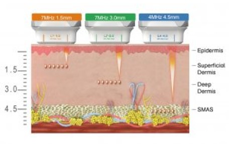 HIFU Có FDA Không? Sự Thật Nhiều Spa Đang Hiểu Sai Về Chứng Nhận FDA