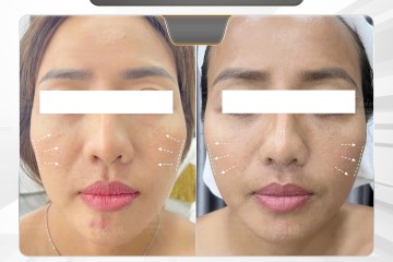 HIFU JESMAS – Công Nghệ Nâng Cơ Không Xâm Lấn Hiệu Quả Thực Tế