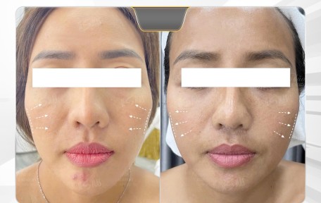 HIFU JESMAS – Công Nghệ Nâng Cơ Không Xâm Lấn Hiệu Quả Thực Tế