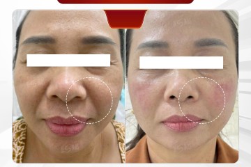 HIFU có hiệu quả thật không? 3 Case thực tế và đánh giá chuyên sâu