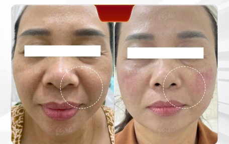 HIFU có hiệu quả thật không? 3 Case thực tế và đánh giá chuyên sâu