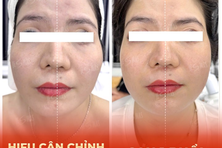 Dịch Vụ Hifu cân chỉnh mặt lệch - má hóp