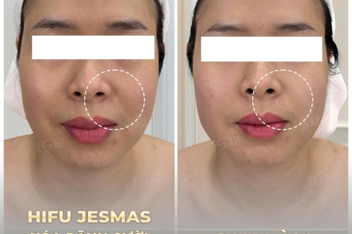 Dịch Vụ Hifu Xóa Rãnh Cười - Nâng Má Xệ