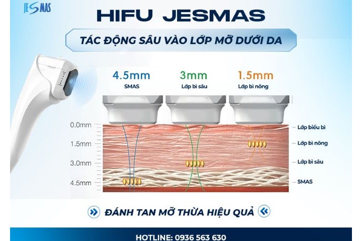 Ưu điểm HIFU Jesmas - cải tiến – Giảm đau, tăng tính linh hoạt