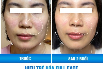 Nâng Cơ HIFU Có Hiệu Quả Không? Review Thực Tế Sau 1–3 Tháng