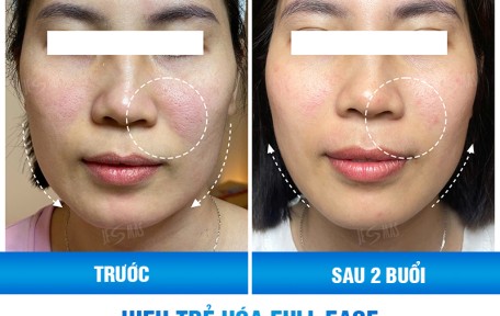 Nâng Cơ HIFU Có Hiệu Quả Không? Review Thực Tế Sau 1–3 Tháng