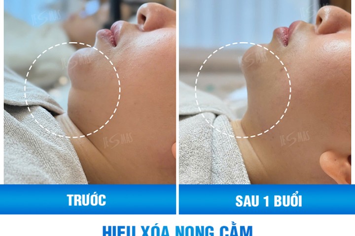 Tạo V-line giảm nọng cằm