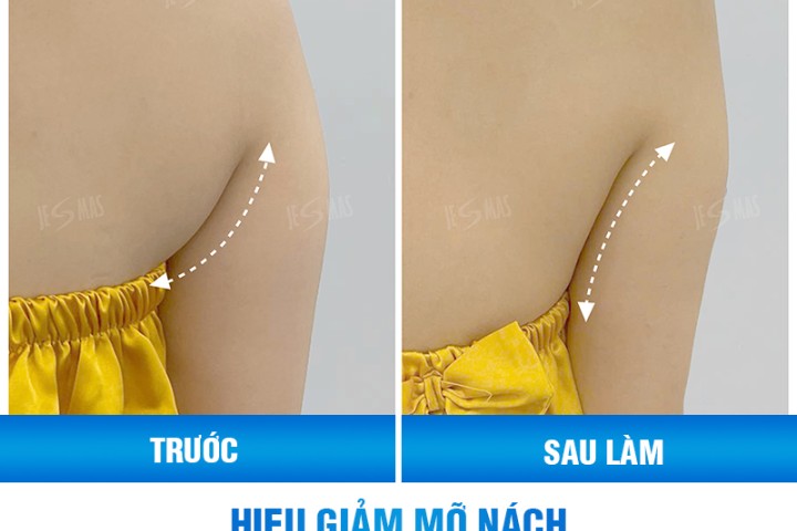 Xóa mỡ thừa tạo đường nét cơ thể