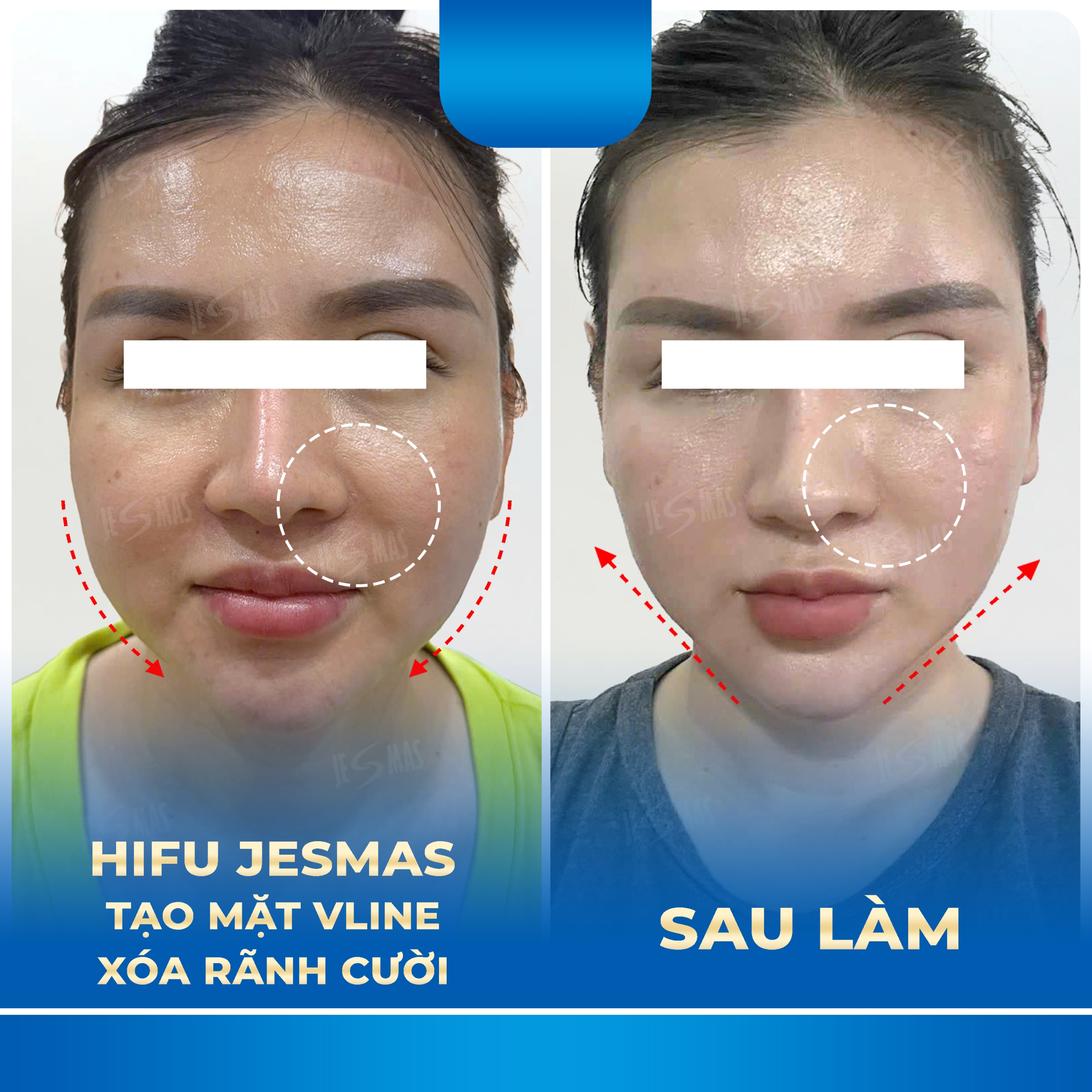 HIFU Jesmas tạo mặt V-line 