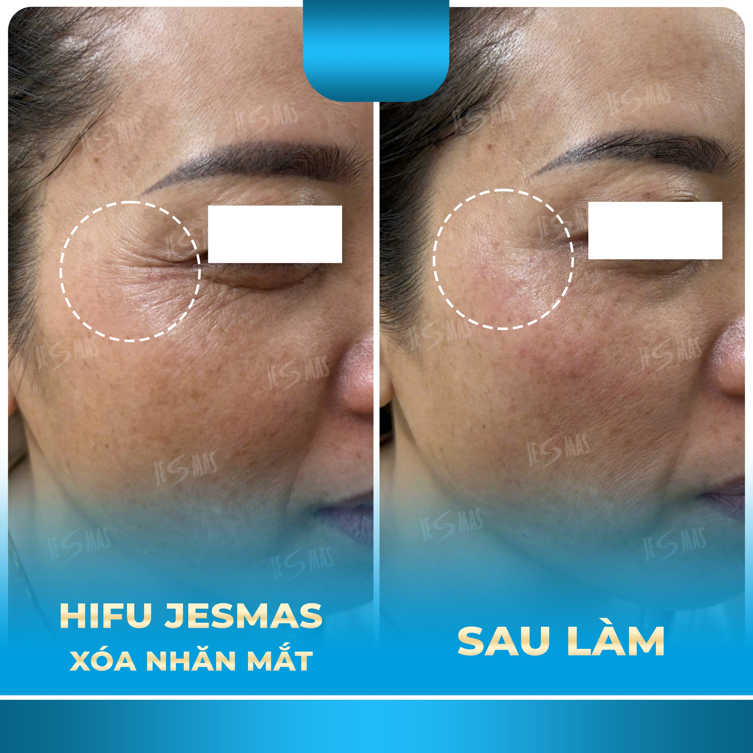 Hifu Xóa tan nỗi lo nhăn mắt