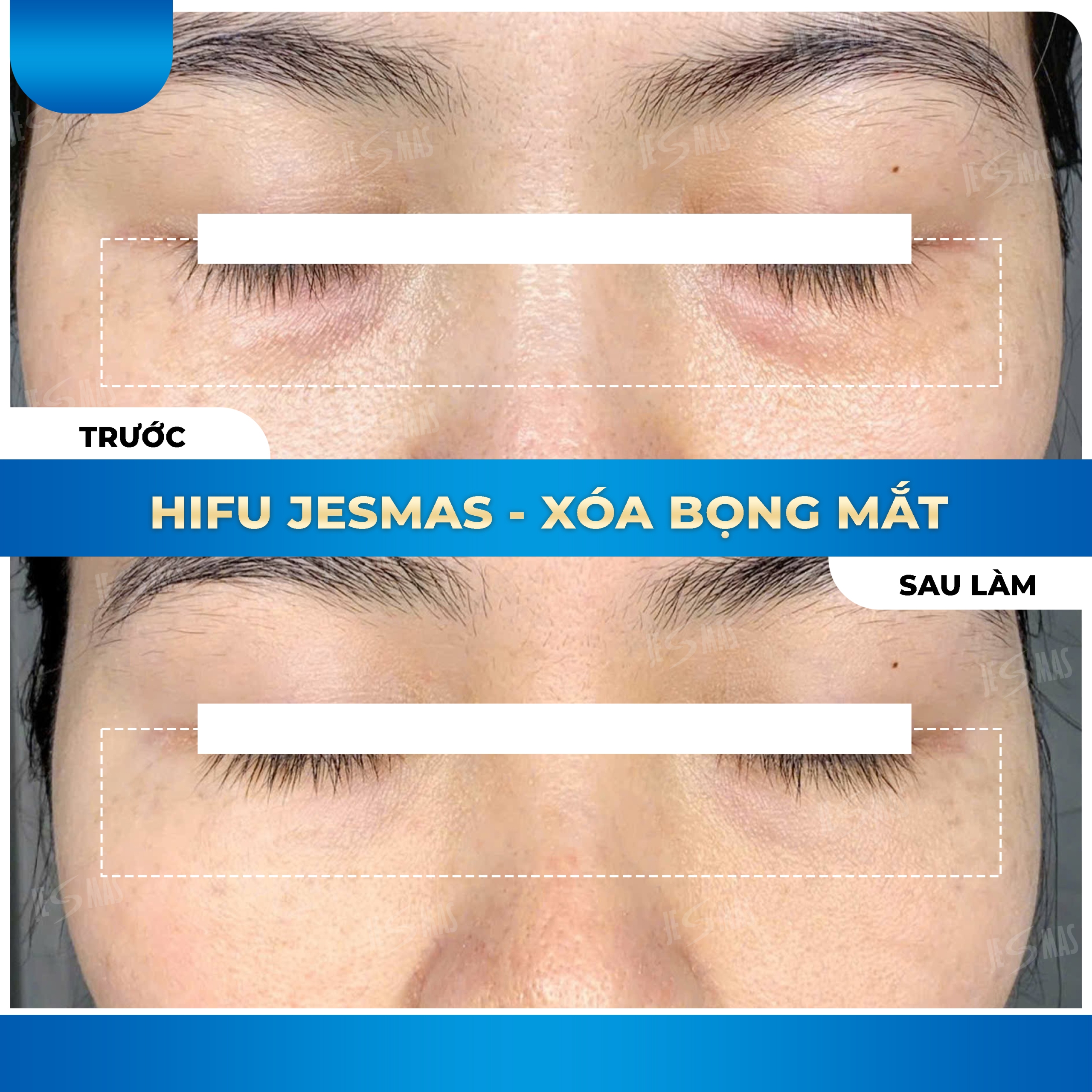 Jesmas Xóa Bọng Mắt Chuẩn Y Khoa