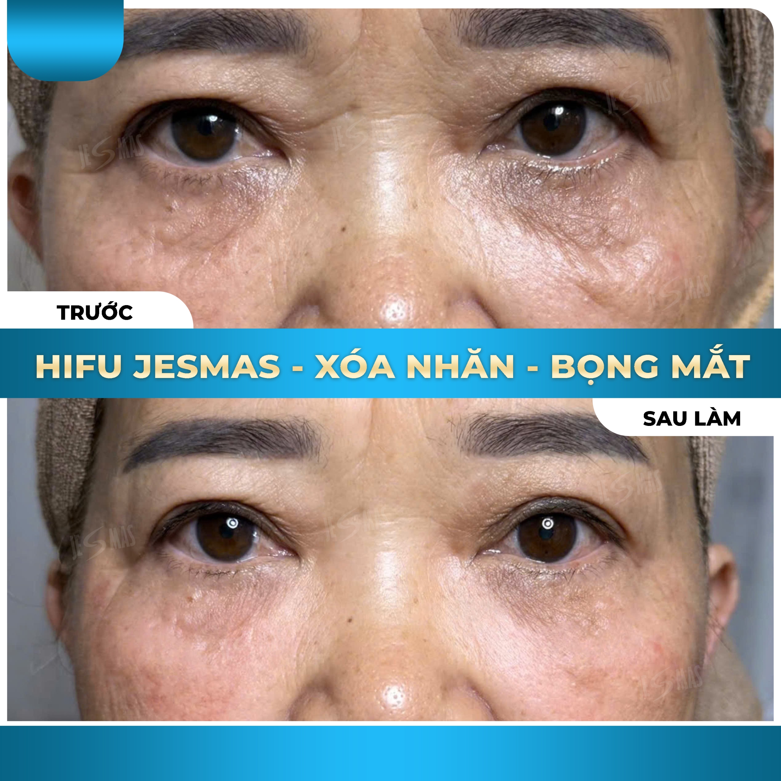Jesmas Xóa Bọng Mắt Chuẩn Y Khoa