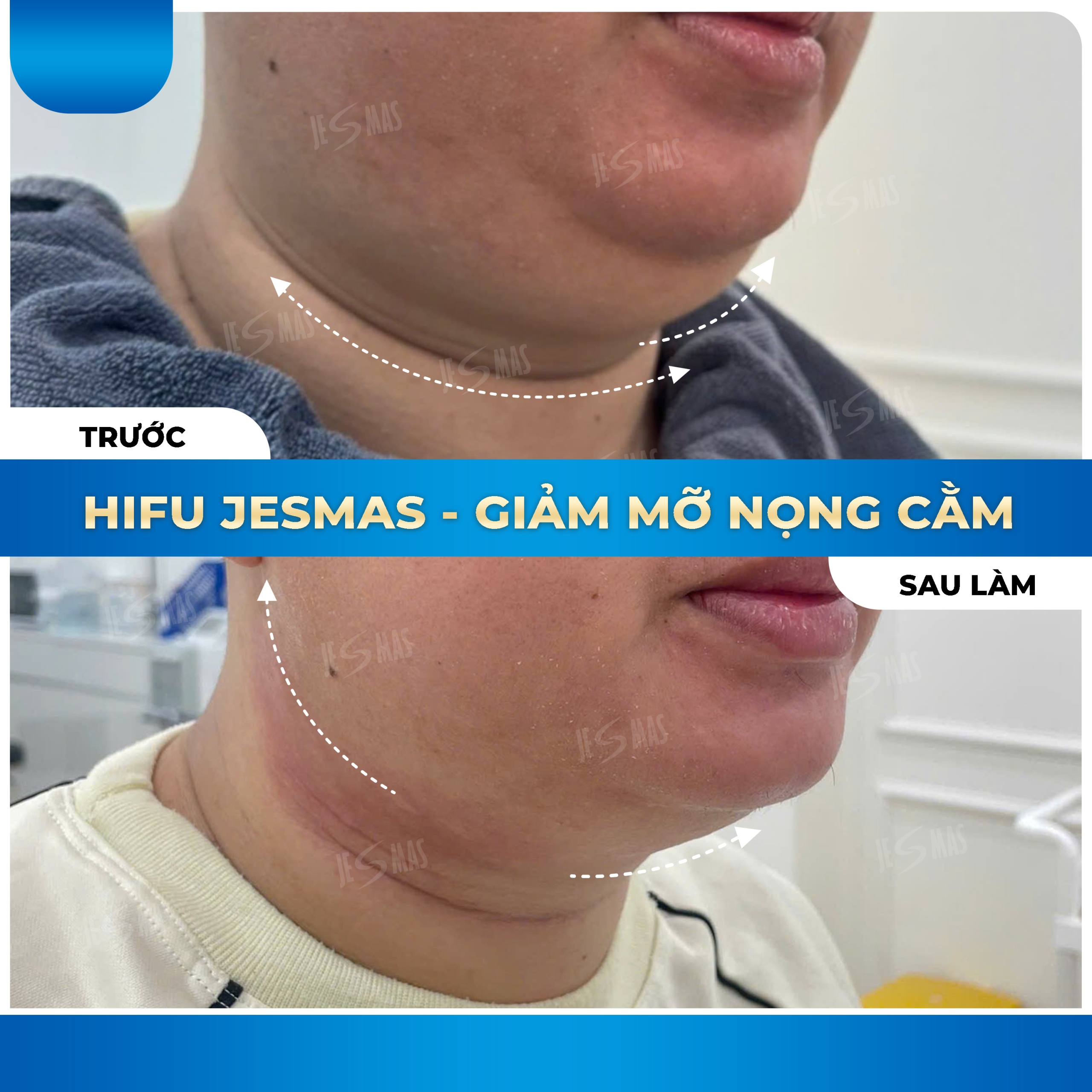 Dịch vụ hifu nọng cằm tại sviet spa