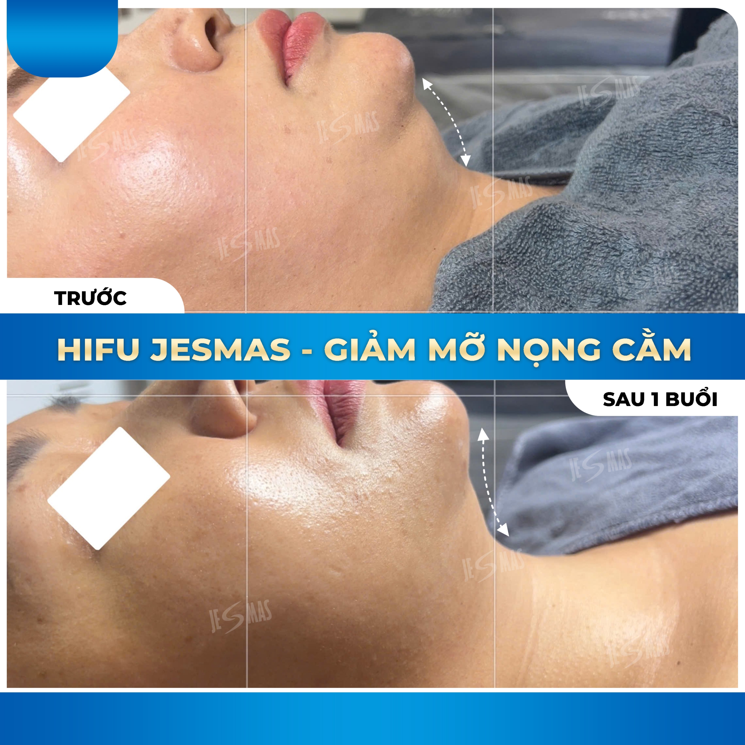 Dịch vụ HIFU nọng cằm là lựa chọn lý tưởng 