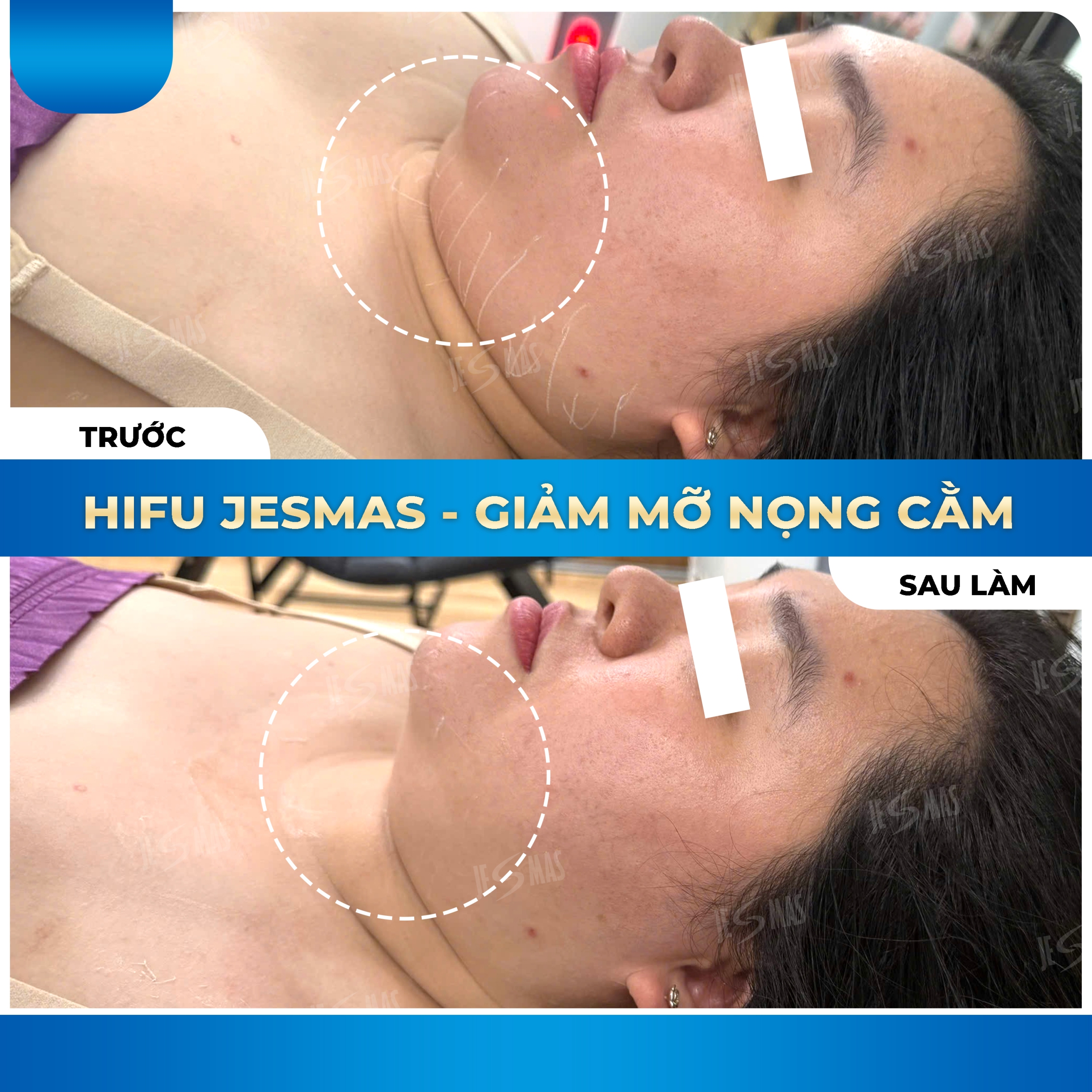 Dịch vụ HIFU nọng cằm là lựa chọn lý tưởng 