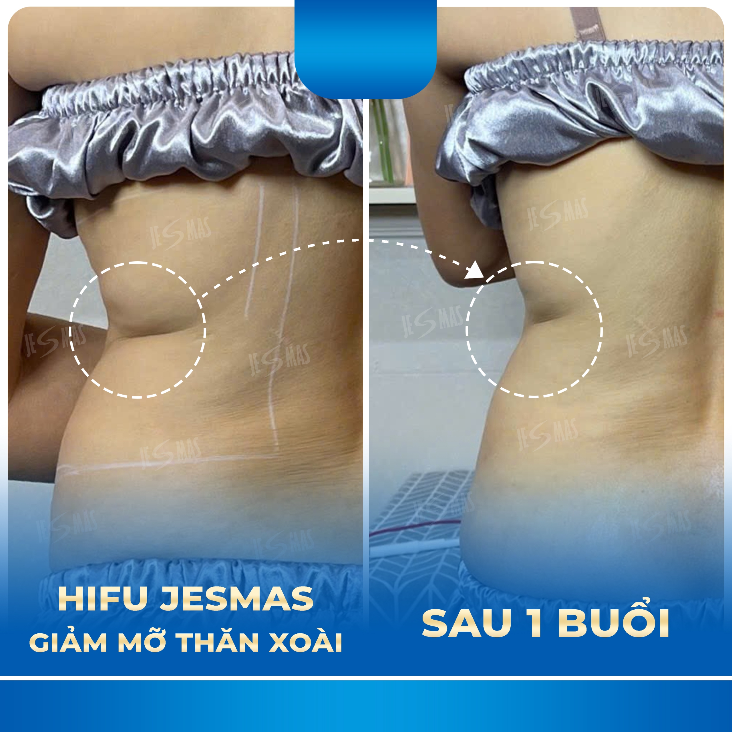 HIFU Giảm Mỡ Thăn Xoài