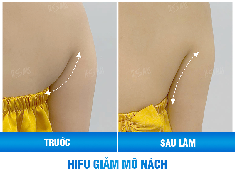 giảm mỡ nách bằng công nghệ hifu