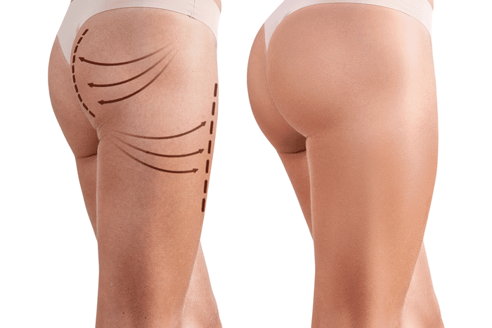 Nâng Cơ Mông Bằng HIFU Tại Sviet Beauty Spa