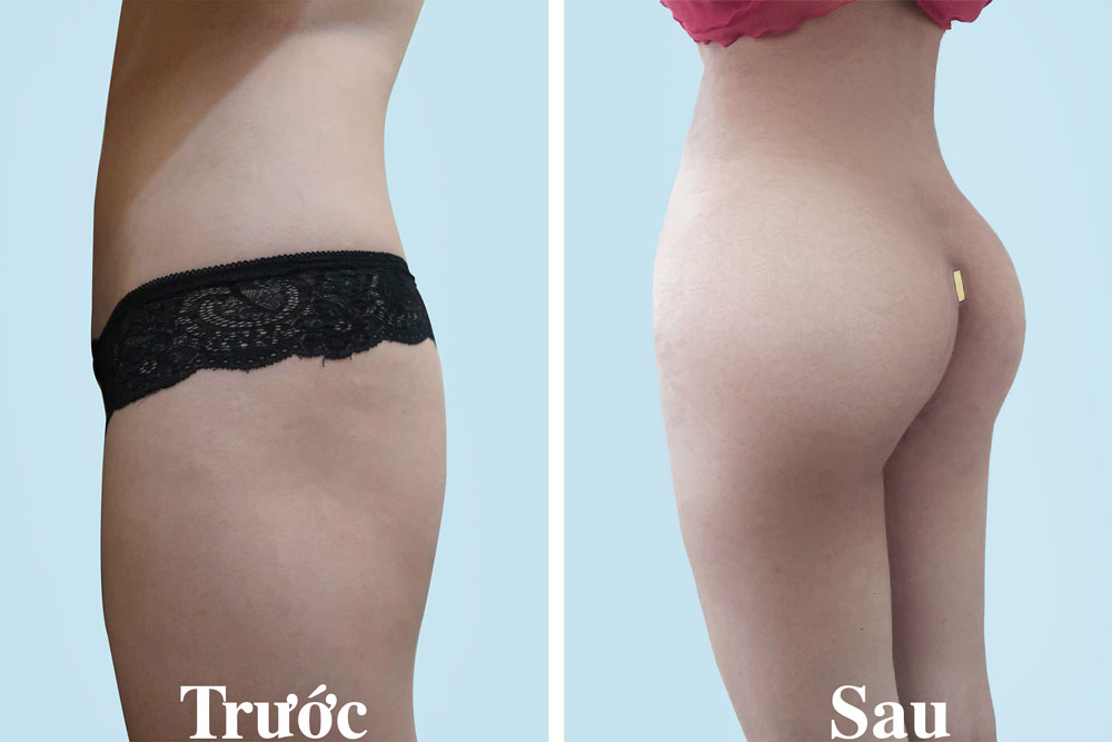 Nâng Cơ Mông Bằng HIFU Tại Sviet Beauty Spa