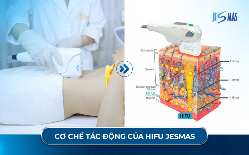 Hifu Công nghệ trẻ hóa da chuẩn y khoa