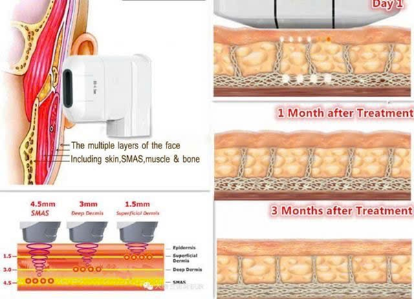 HIFU Tác Động Lên Da Như Thế Nào?