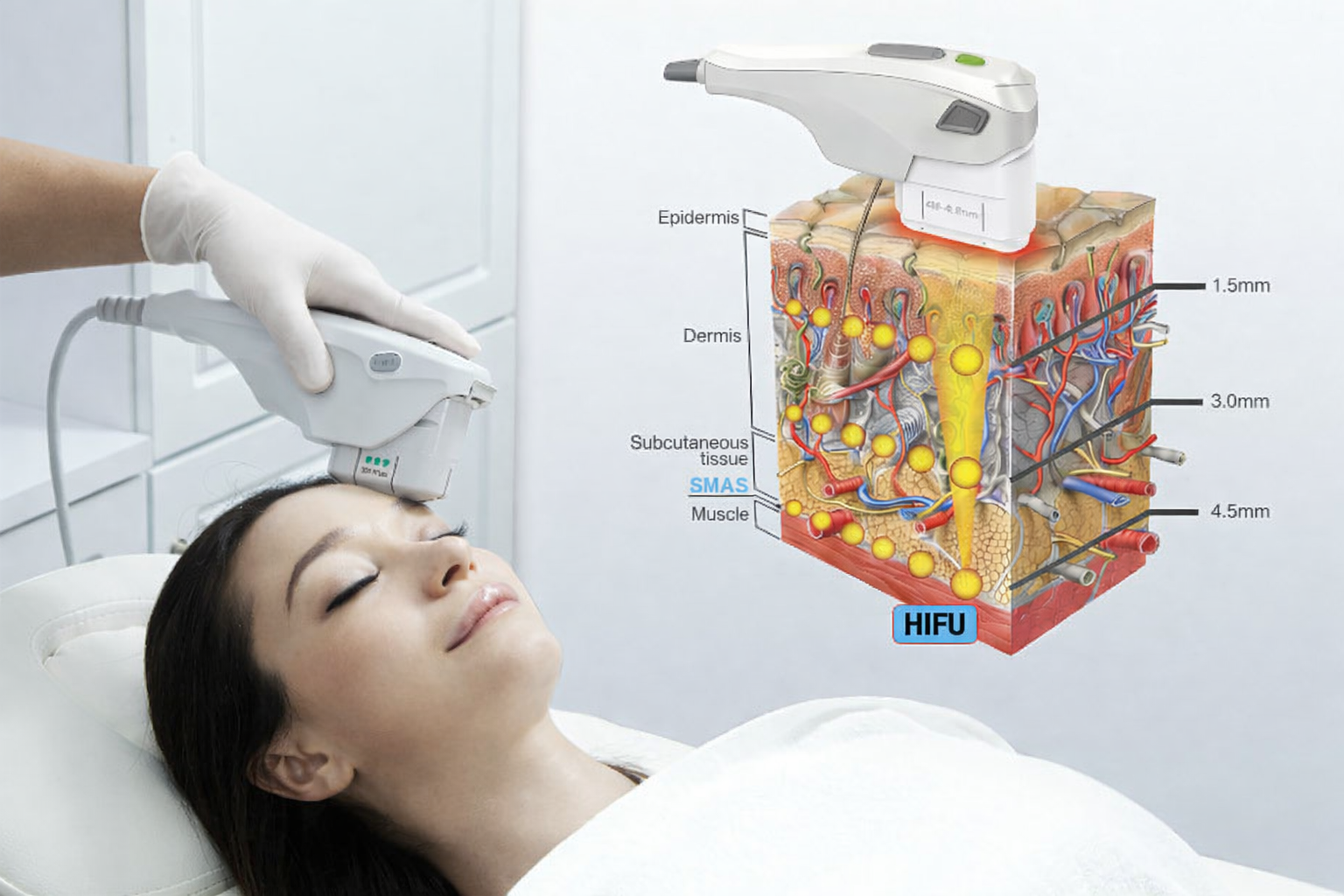 Công nghệ máy hifu