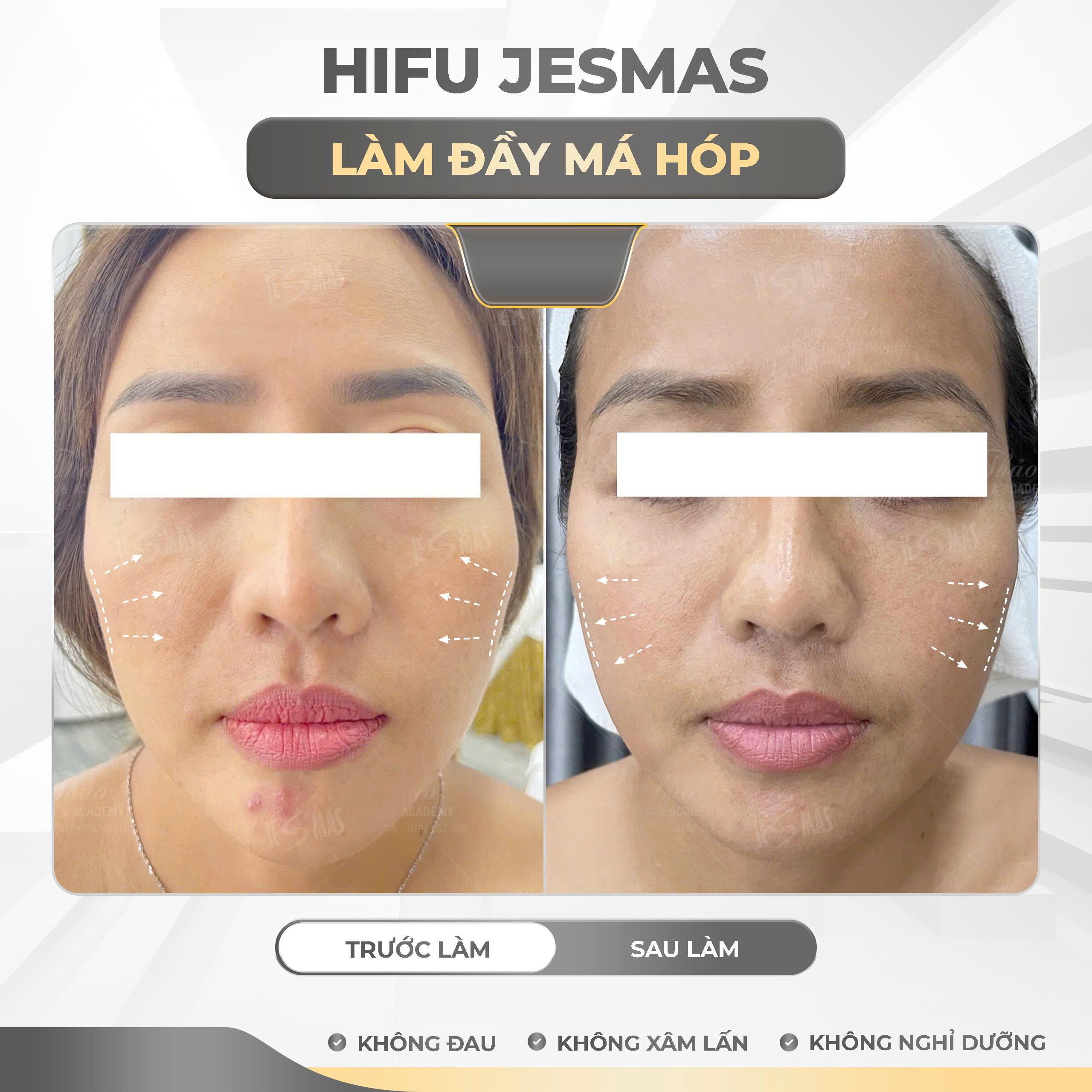 Dịch vụ Hifu jesmas