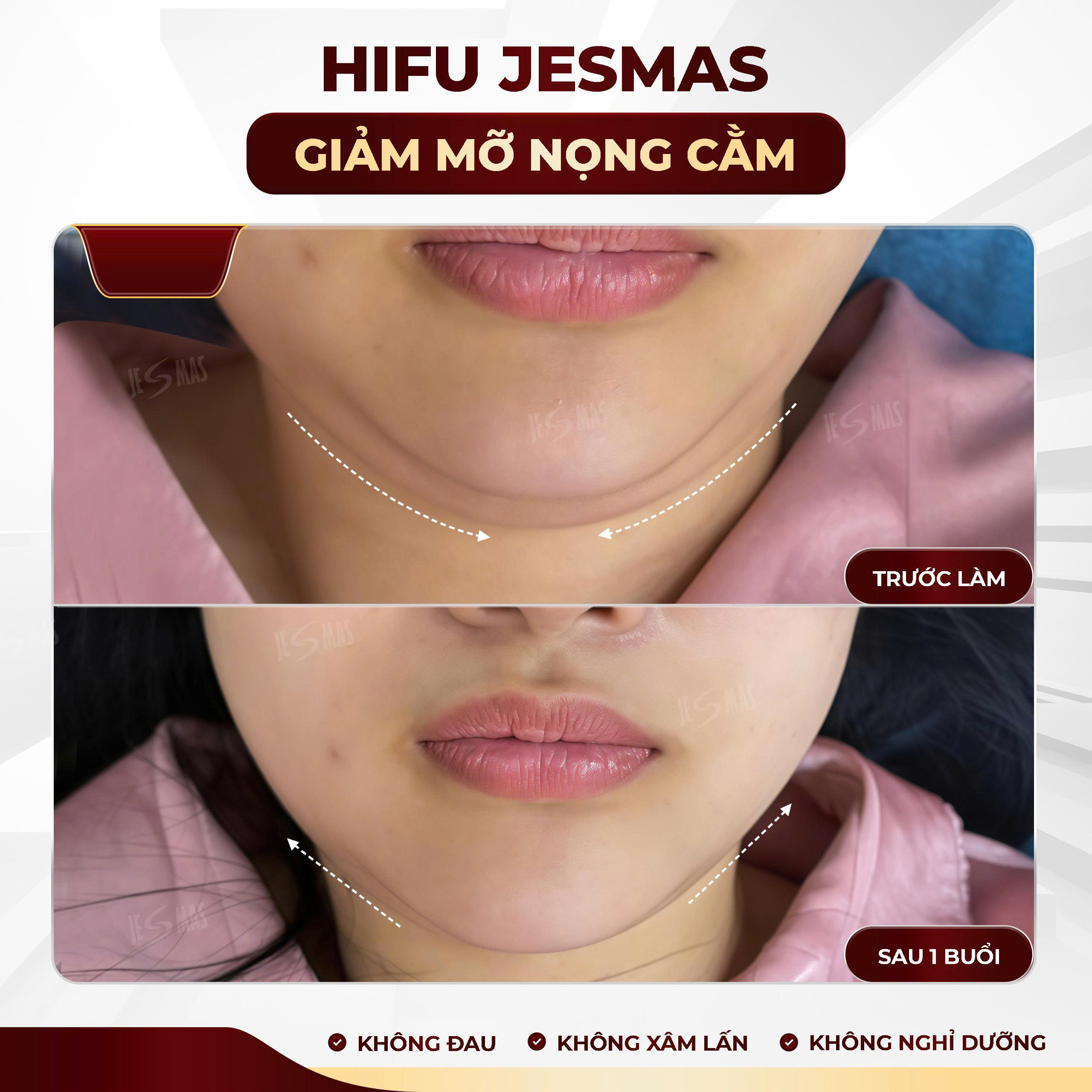 Giảm mỡ nọng cằm 