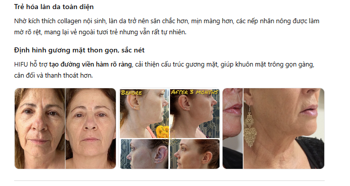 Ứng dụng của nâng cơ HIFU trong trẻ hóa da