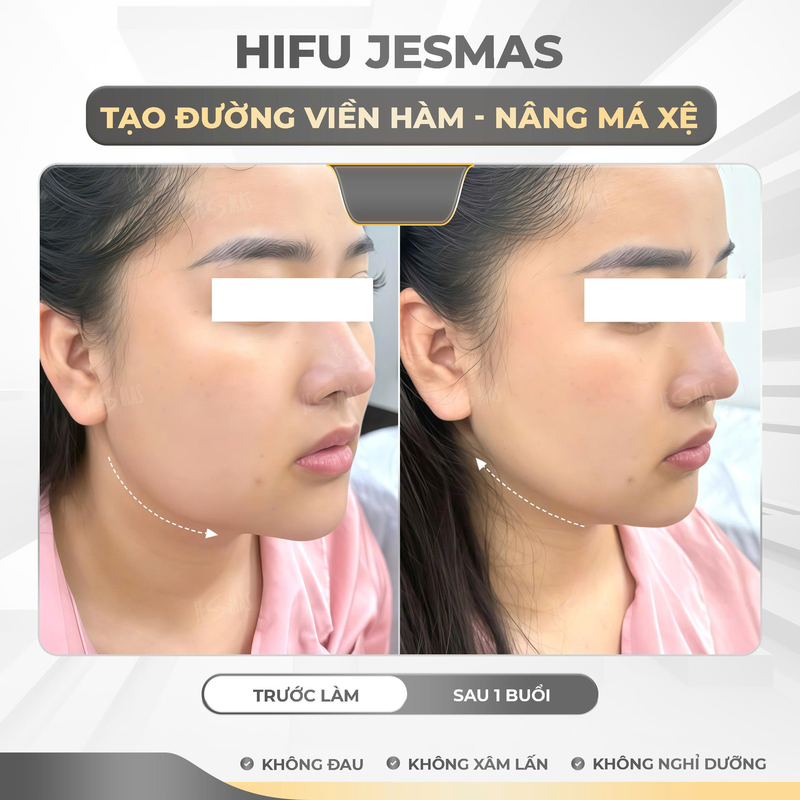 Dịch vụ nâng cơ má xệ bằng công nghệ máy hifu