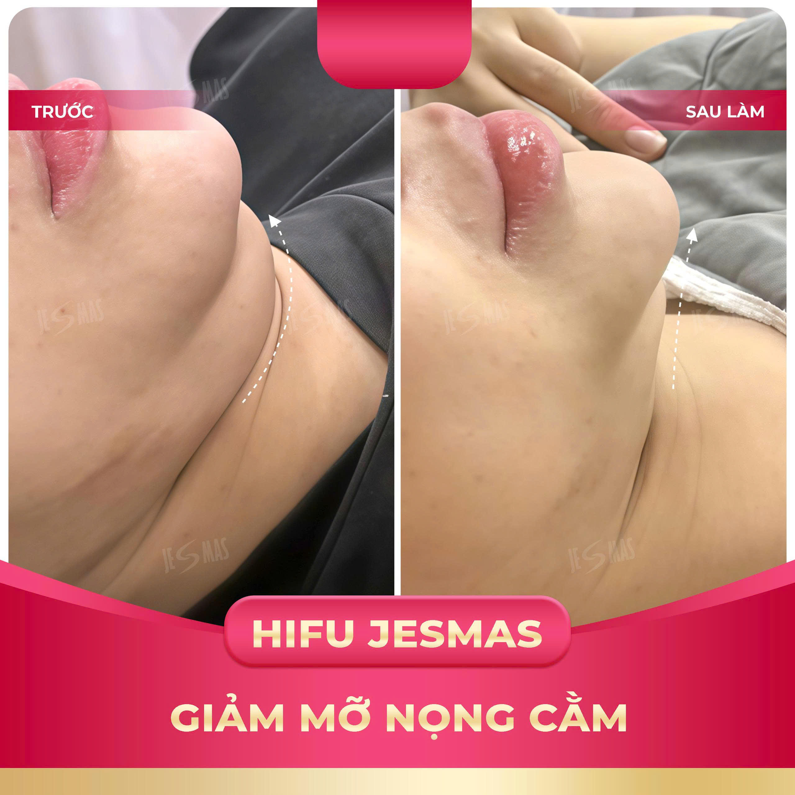 Ứng dụng của nâng cơ HIFU trong trẻ hóa da