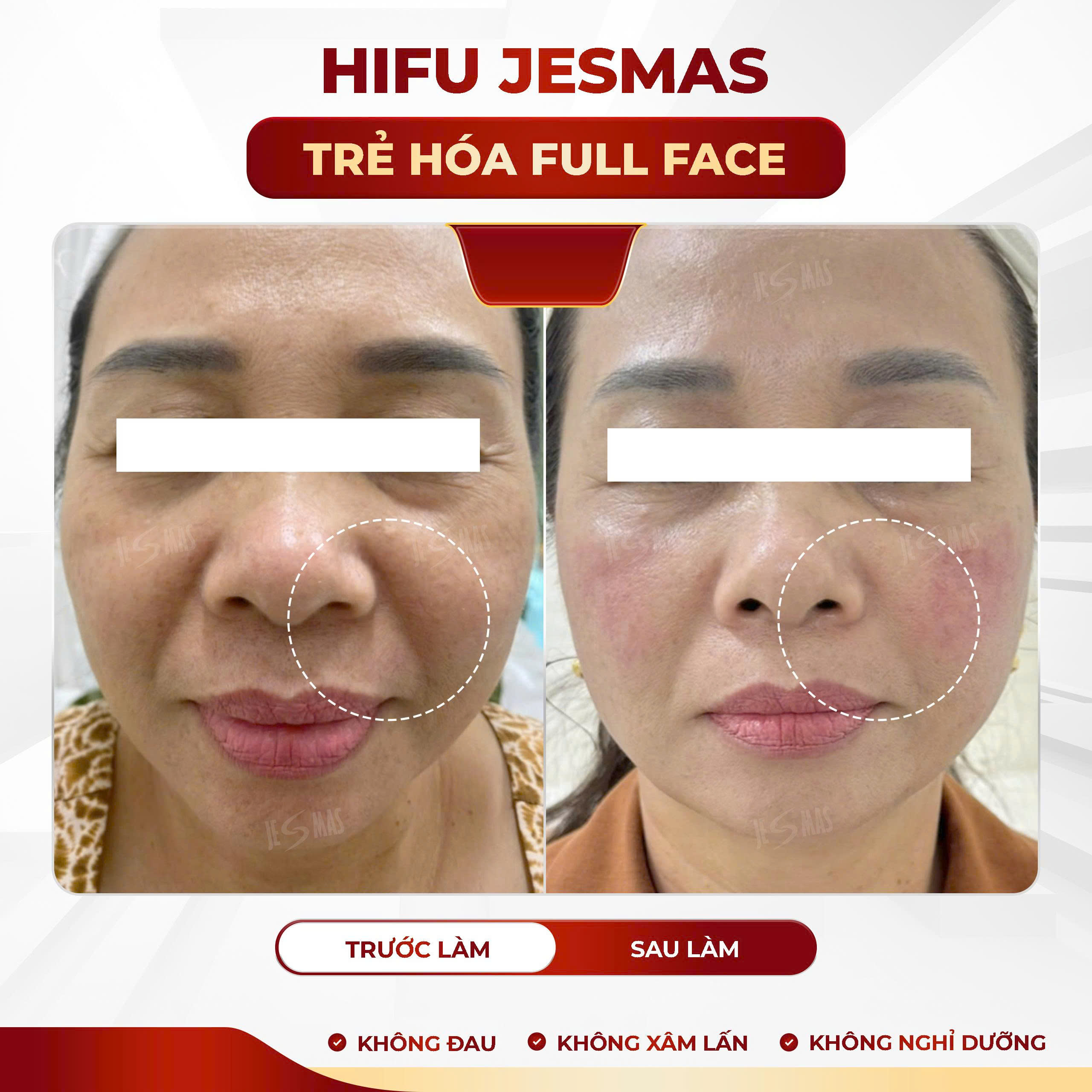 Dịch vụ  trẻ hoá da bằng công nghệ hifu