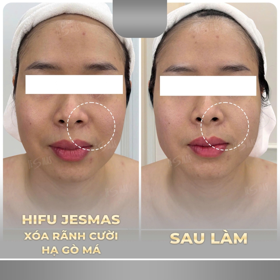 Hiệu Quả Sau Khi Làm HIFU Xóa Rãnh Cười – Nâng Cơ Má Xệ